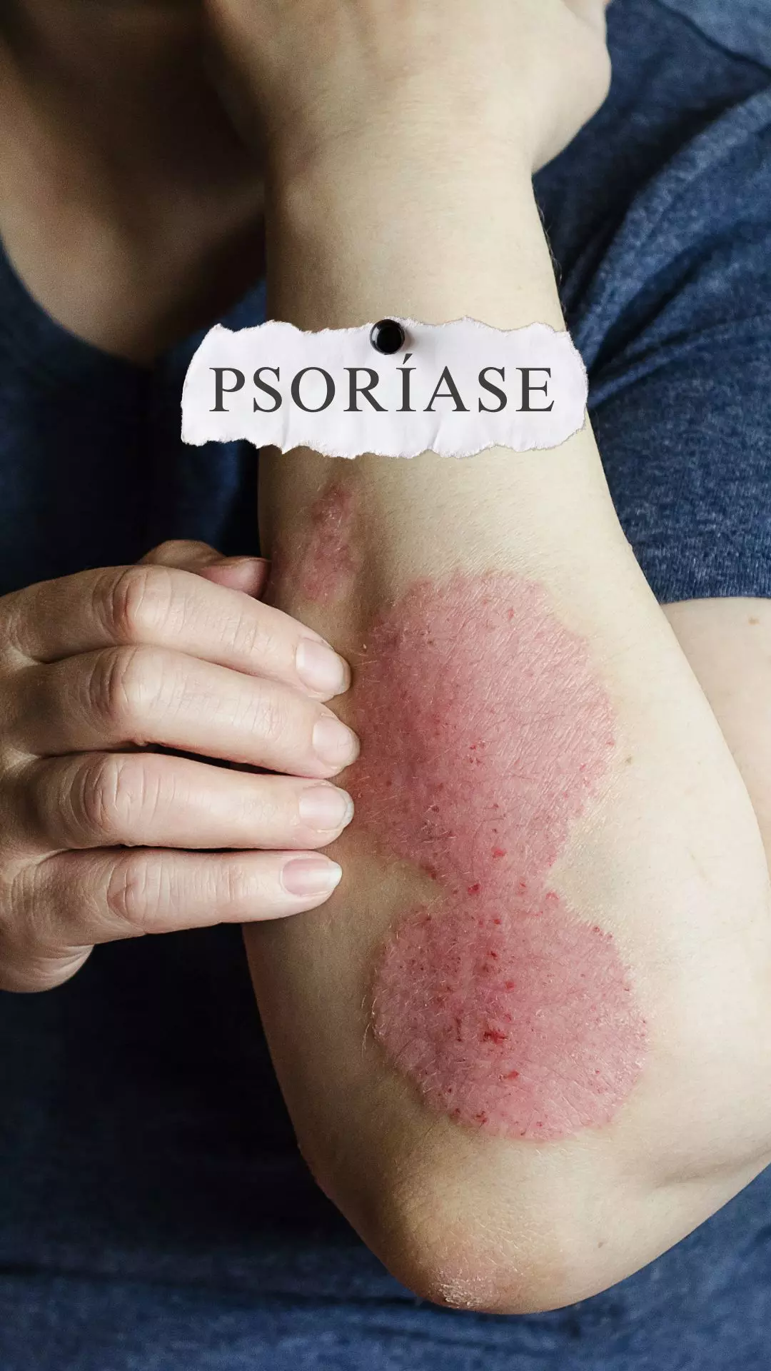 gluten psoriasis