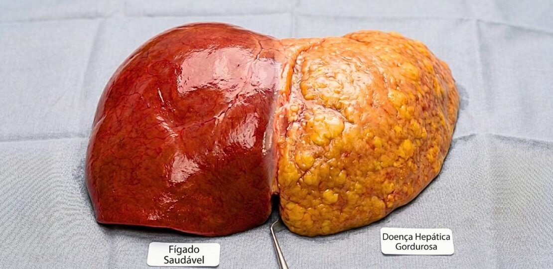 gordura no fígado causada pelo açúcar